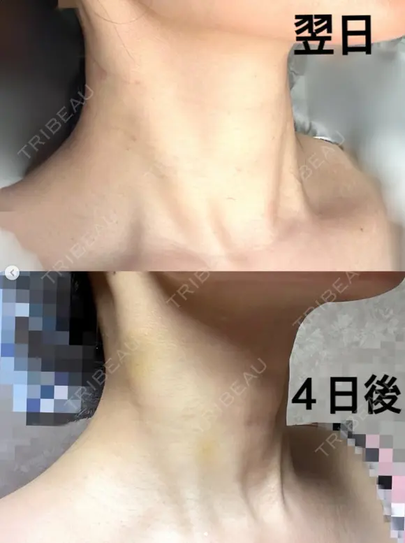 Dr都築⭐️スネコス注射⭐️ after画像 メイン用