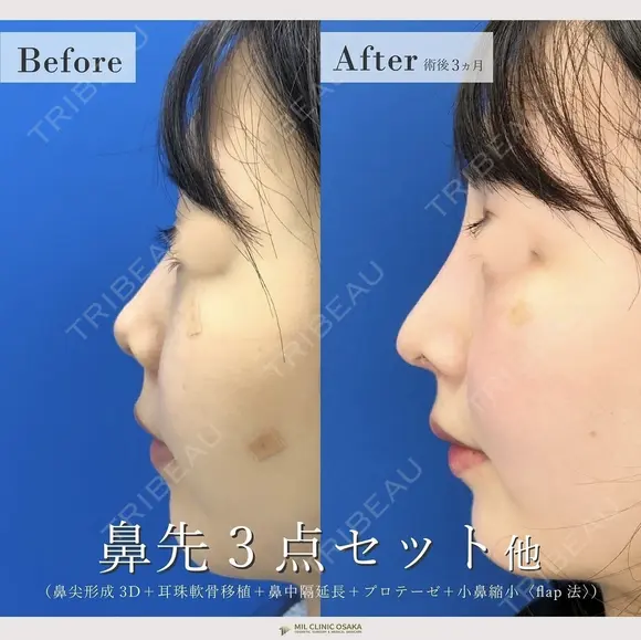 鼻尖形成3D＋鼻尖部軟骨移植＋鼻中隔延長＋プロテーゼ＋小鼻縮小(flap法) after画像 メイン用