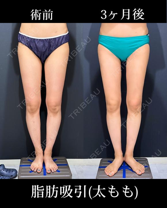 太ももの脂肪吸引 before画像 メイン用