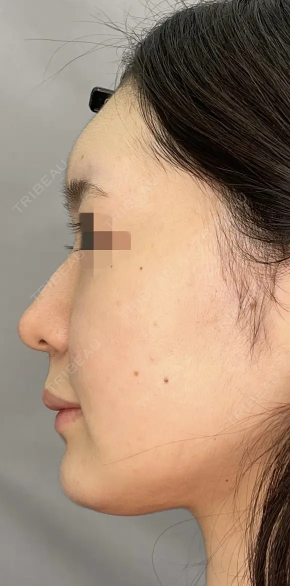 耳介軟骨移植＋鼻尖形成＋プロテーゼ before画像 メイン用