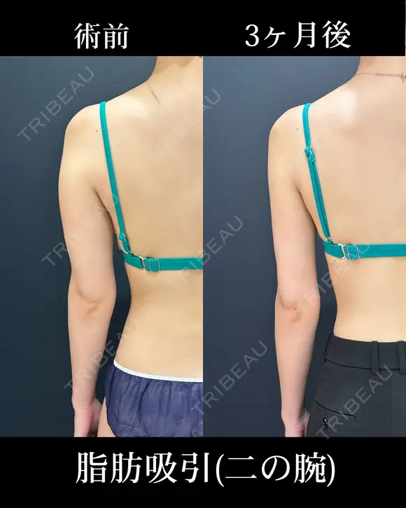 二の腕の脂肪吸引 before画像 メイン用