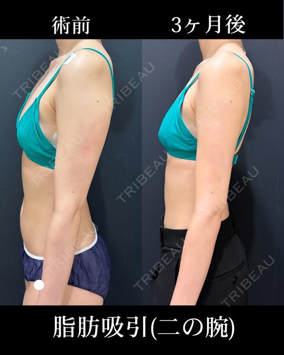 二の腕の脂肪吸引 before画像 メイン用