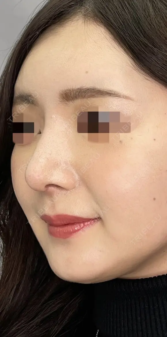 耳介軟骨移植＋鼻尖形成＋プロテーゼ 30日後 メイン用
