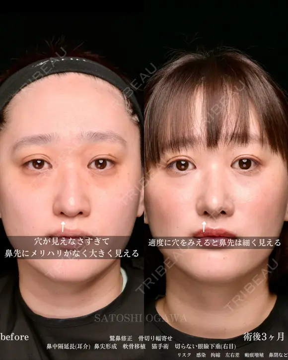 耳介軟骨を使用した鼻整形 before画像 メイン用