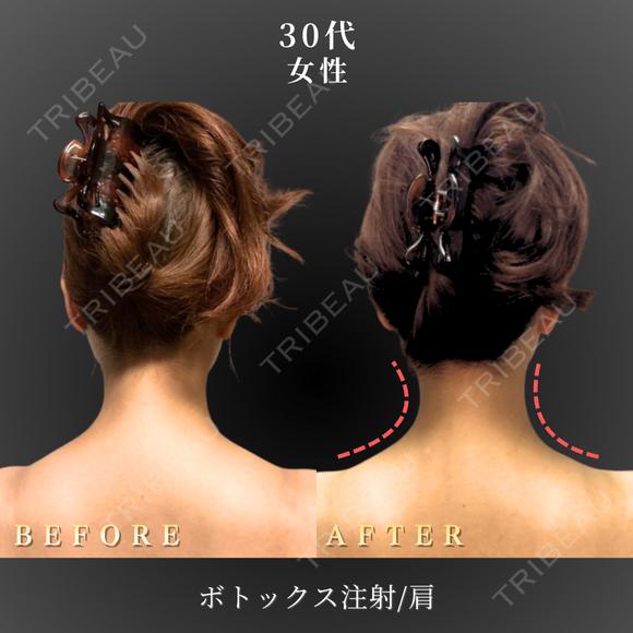 肩ボトックス after画像 メイン用