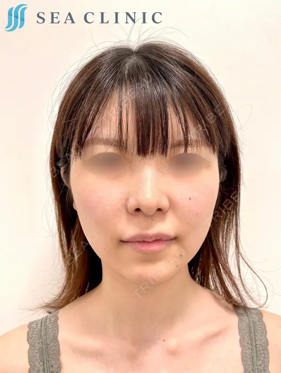SEAライン3D脂肪吸引(頬・顎下)/メーラーファット/糸リフト6本   before画像 メイン用