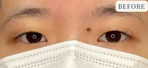 二重埋没法（線留め） before画像 メイン用