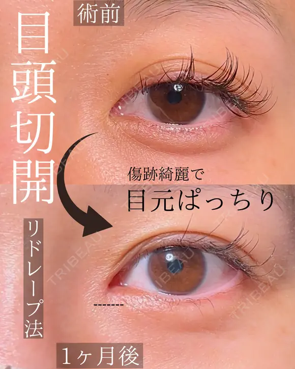 目頭切開 30日後 メイン用