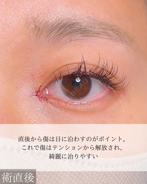 目頭切開 30日後 メイン用