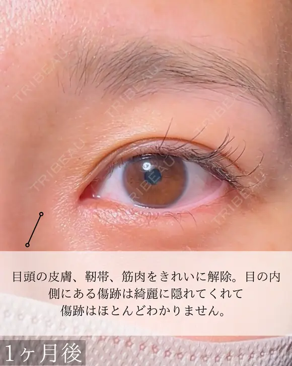目頭切開 30日後 メイン用