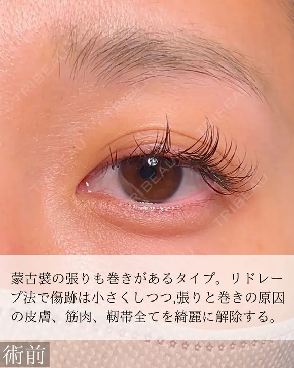 目頭切開 before画像 メイン用