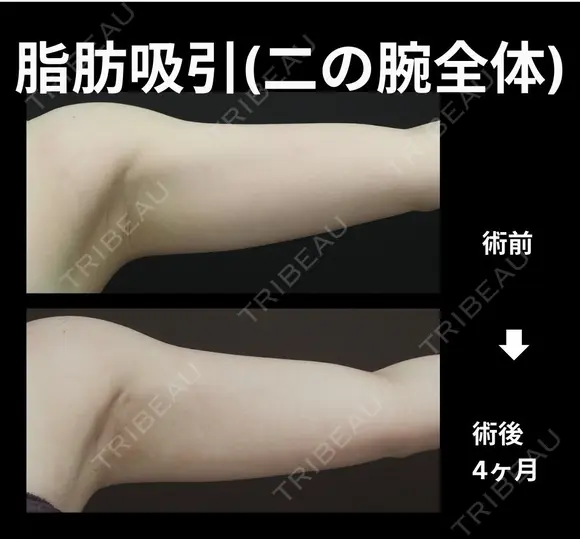 二の腕全体脂肪吸引 30日後 メイン用
