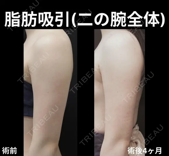 二の腕全体脂肪吸引 30日後 メイン用