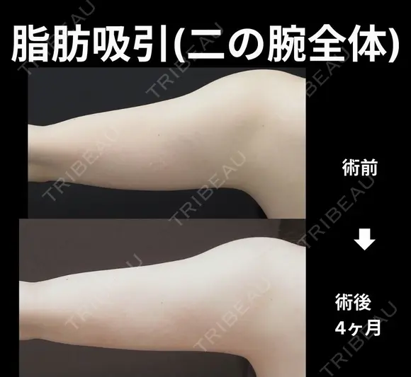 二の腕全体脂肪吸引 30日後 メイン用