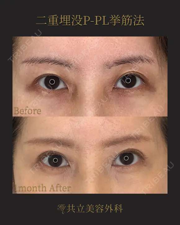 共立式二重埋没P-PL挙筋法 before画像 メイン用