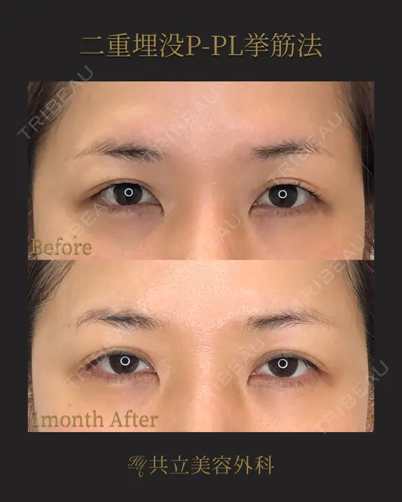 共立式二重埋没P-PL挙筋法 before画像 メイン用