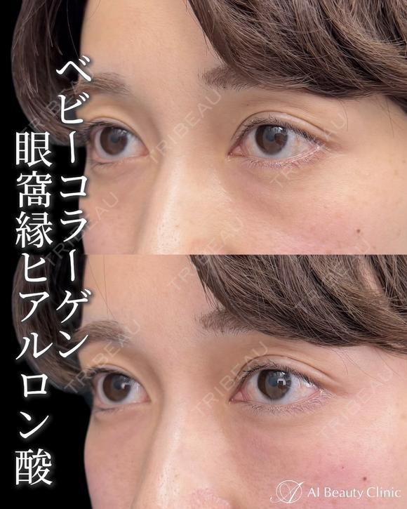 ベビーコラーゲン注射 before画像 メイン用