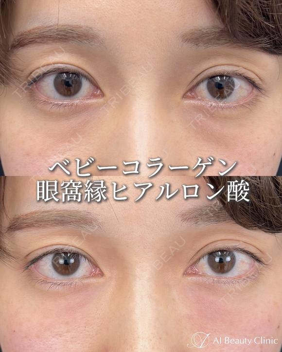 ベビーコラーゲン注射 after画像 メイン用