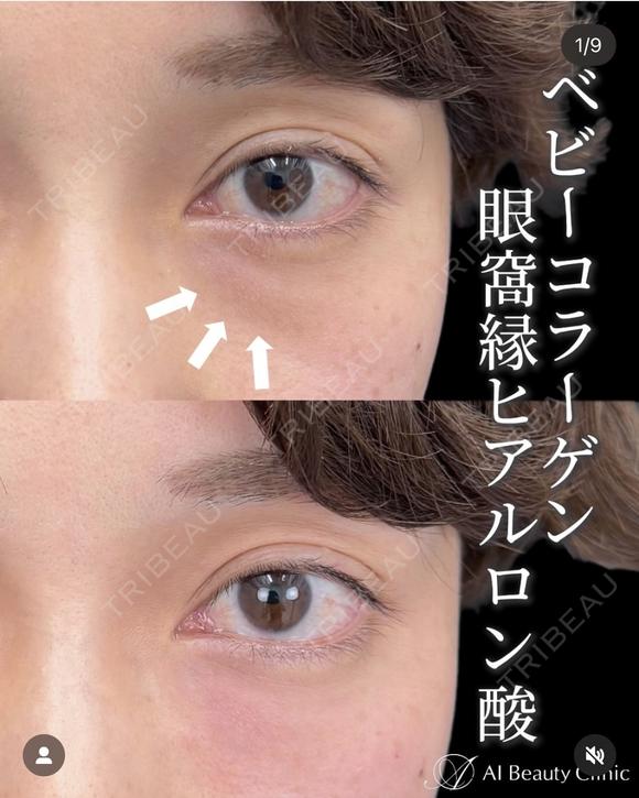 ベビーコラーゲン注射 after画像 メイン用