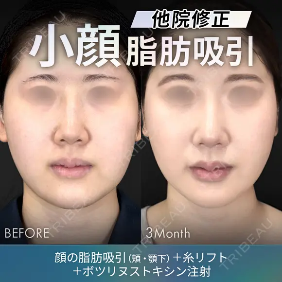 他院修正脂肪吸引（顔2部位）＋糸リフト＋ボツリヌストキシン注射 before画像 メイン用