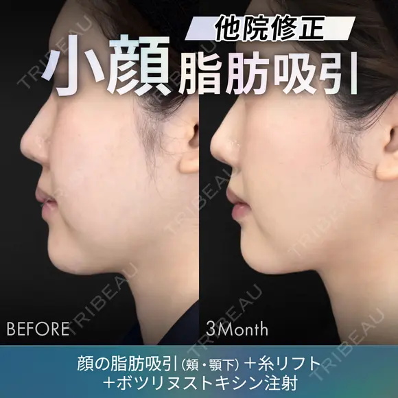 他院修正脂肪吸引（顔2部位）＋糸リフト＋ボツリヌストキシン注射 after画像 メイン用