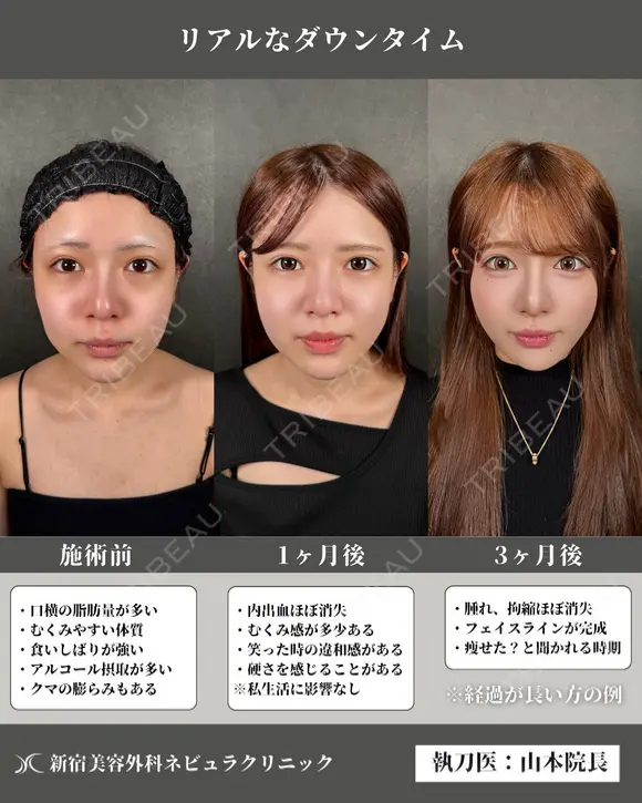 🎀完全保存版🎀小顔整形のダウンタイムを公開📸 before画像 メイン用