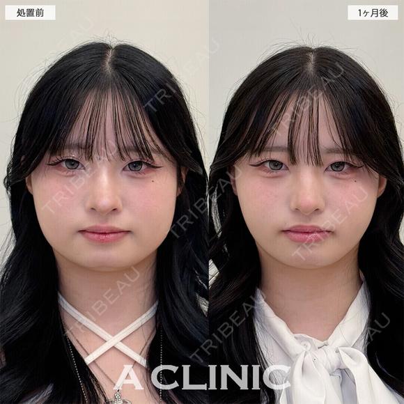 【1day小顔＋小顔エラボトックス】下膨れ顔解消しました！こちら処置前と1ヶ月後の症例です before画像 メイン用