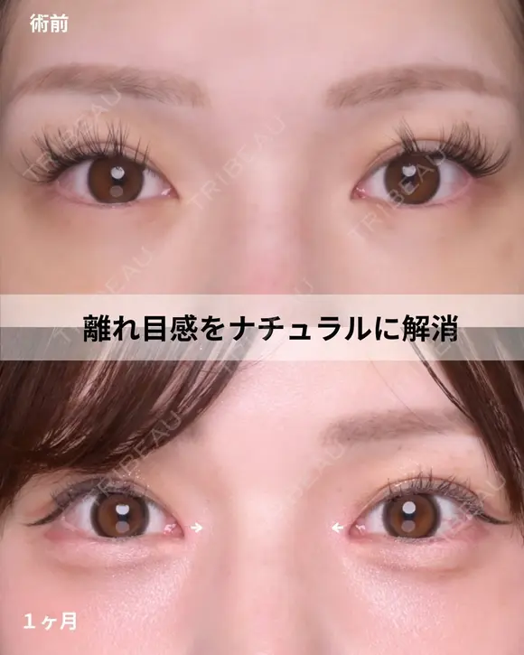 韓流目頭切開 before画像 メイン用