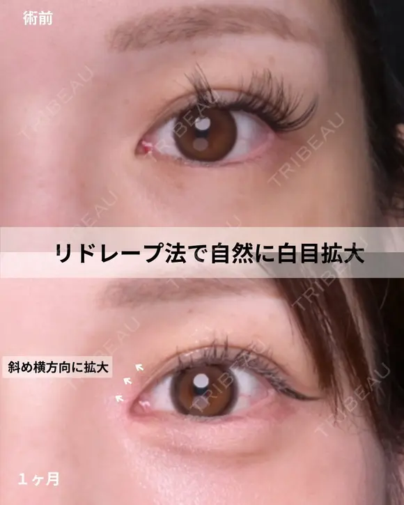 韓流目頭切開 30日後 メイン用