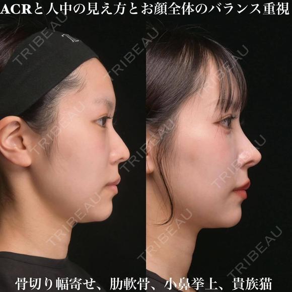 ACRと人中の見え方とお顔全体のバランス重視 90日後 メイン用