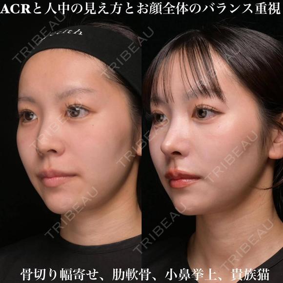 ACRと人中の見え方とお顔全体のバランス重視 90日後 メイン用