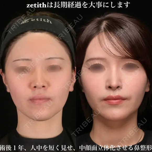ゼティスは長期経過を大事にします。 before画像 メイン用