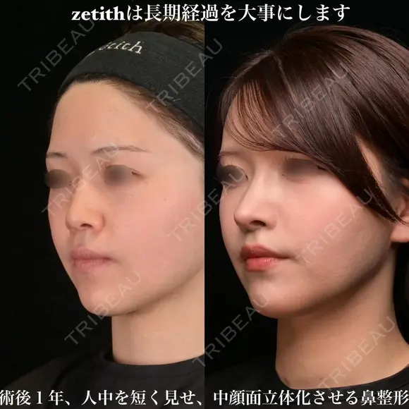 ゼティスは長期経過を大事にします。 365日後 メイン用