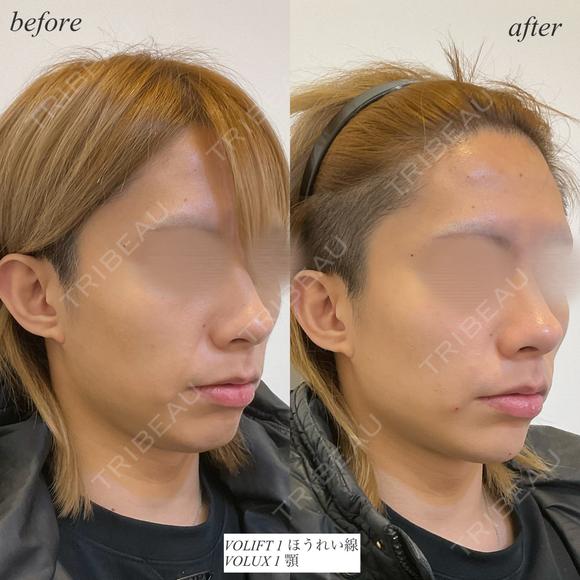 顎ほうれい線ヒアルロン酸 before画像 メイン用