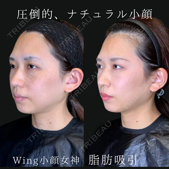Wing小顔女神脂肪吸引 90日後 メイン用