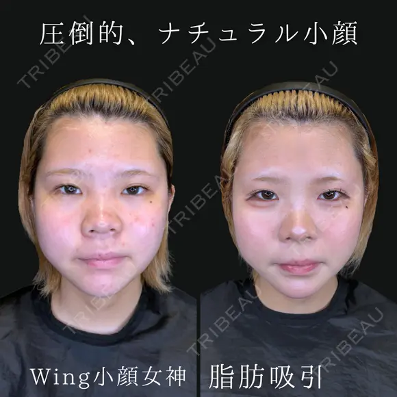 Wing小顔女神脂肪吸引 90日後 メイン用