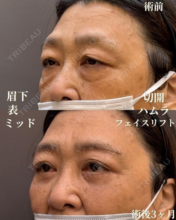 表ハムラ＋ミッドフェイスリフト、眉下切開 90日後 メイン用