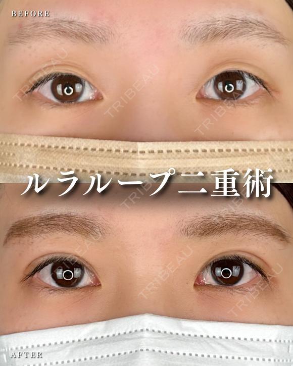 1dayルラループ after画像 メイン用