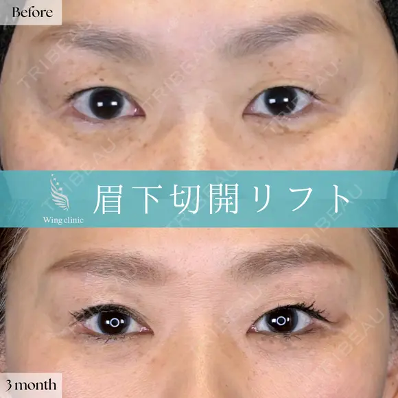 Wing式眉下リフト 90日後 メイン用