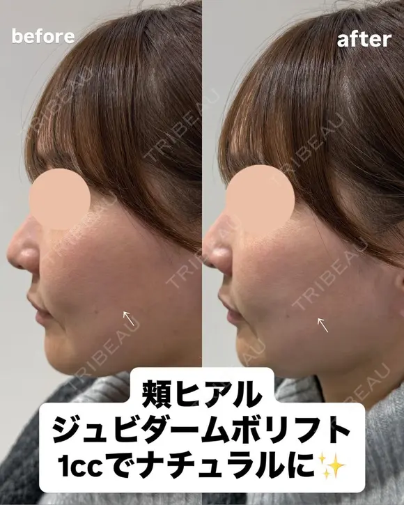 頬ヒアルロン酸✨ after画像 メイン用
