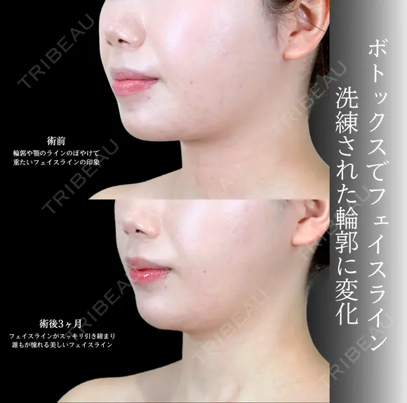 エラボトックス/顎ボトックス 唇ヒアルロン酸/顎ヒアルロン酸 before画像 メイン用
