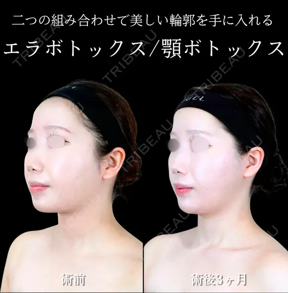 エラボトックス/顎ボトックス 唇ヒアルロン酸/顎ヒアルロン酸 90日後 メイン用