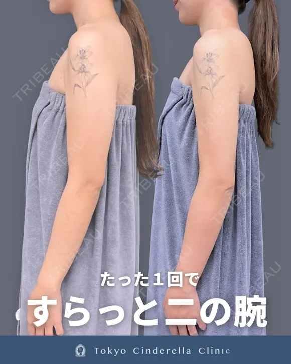アキーセル脂肪吸引(二の腕・肩) 90日後 メイン用