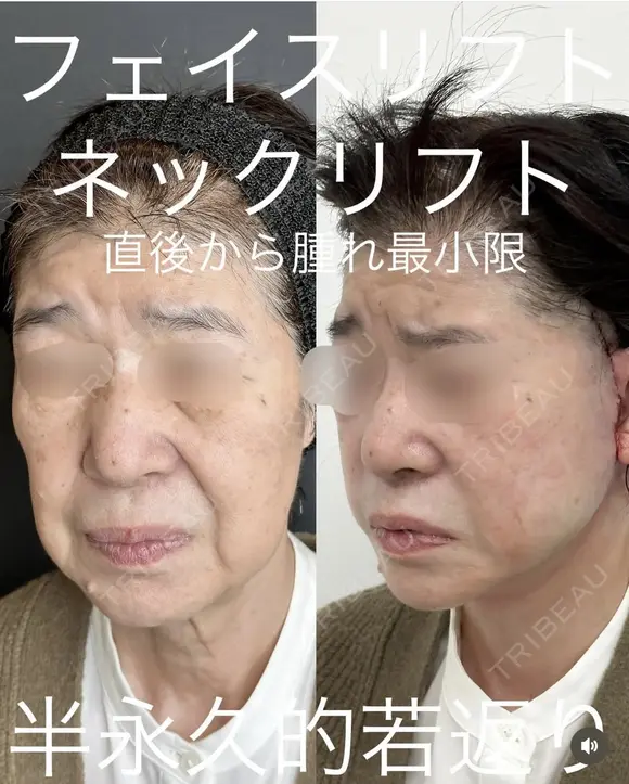 フェイスリフト・ネックリフト before画像 メイン用