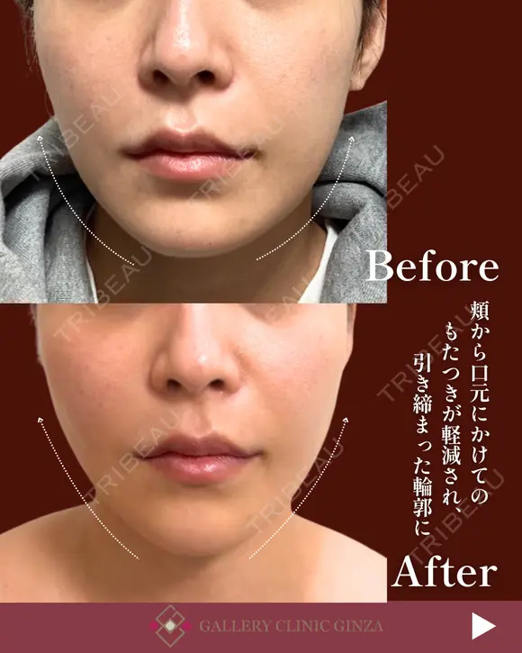 スレッド（糸）リフト after画像 メイン用