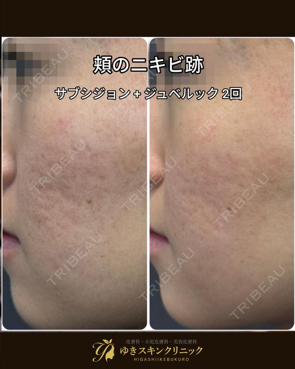 サブシジョン ニキビ跡3cm×3cm｜麻酔代込✨ジュベルックorレニスナ導入＋9,900円で可能💓3倍範囲も可【口コミ1,500件以上】凹凸・クレーターに before画像 メイン用