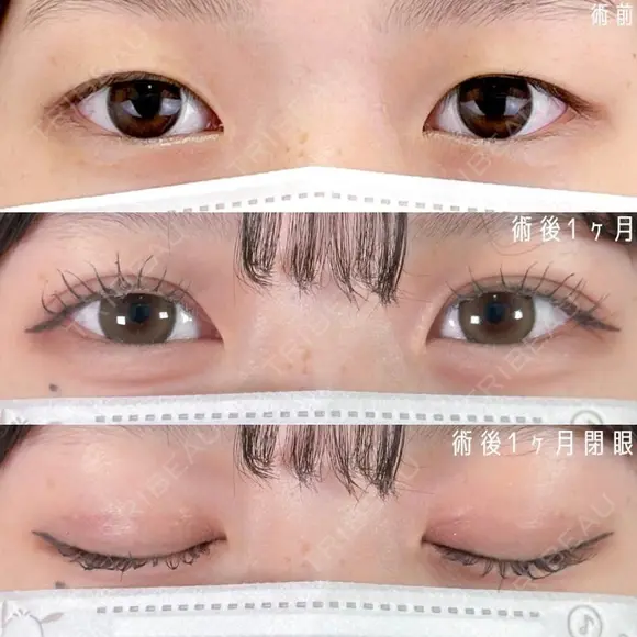 二重埋没法 before画像 メイン用