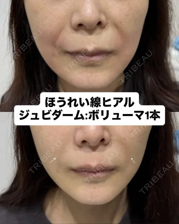 ヒアルロン酸 before画像 メイン用