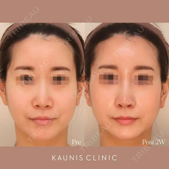 鼻中隔延長、隆鼻、鼻柱下降、鼻翼縮小（内側） after画像 メイン用