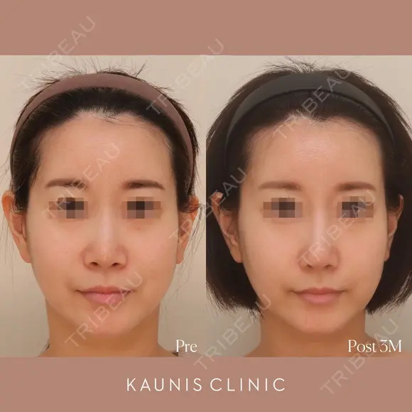 鼻中隔延長、隆鼻、鼻柱下降、鼻翼縮小（内側） after画像 メイン用